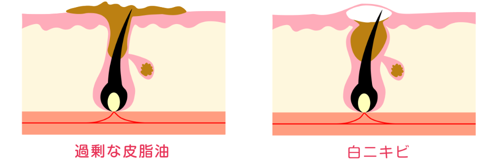 ニキビのホルモン療法